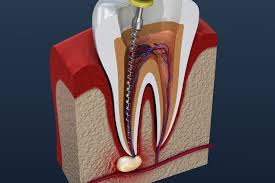 Root Canal Treatment - Medicity Hospital